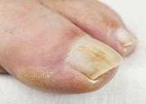 micosi unghie piedi: rimedi naturali e con bicarbonato